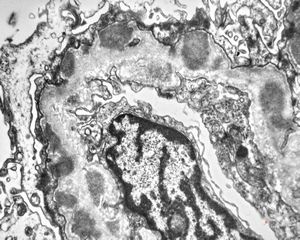 M,7y. | type III membranoproliferative glomerulonephritis